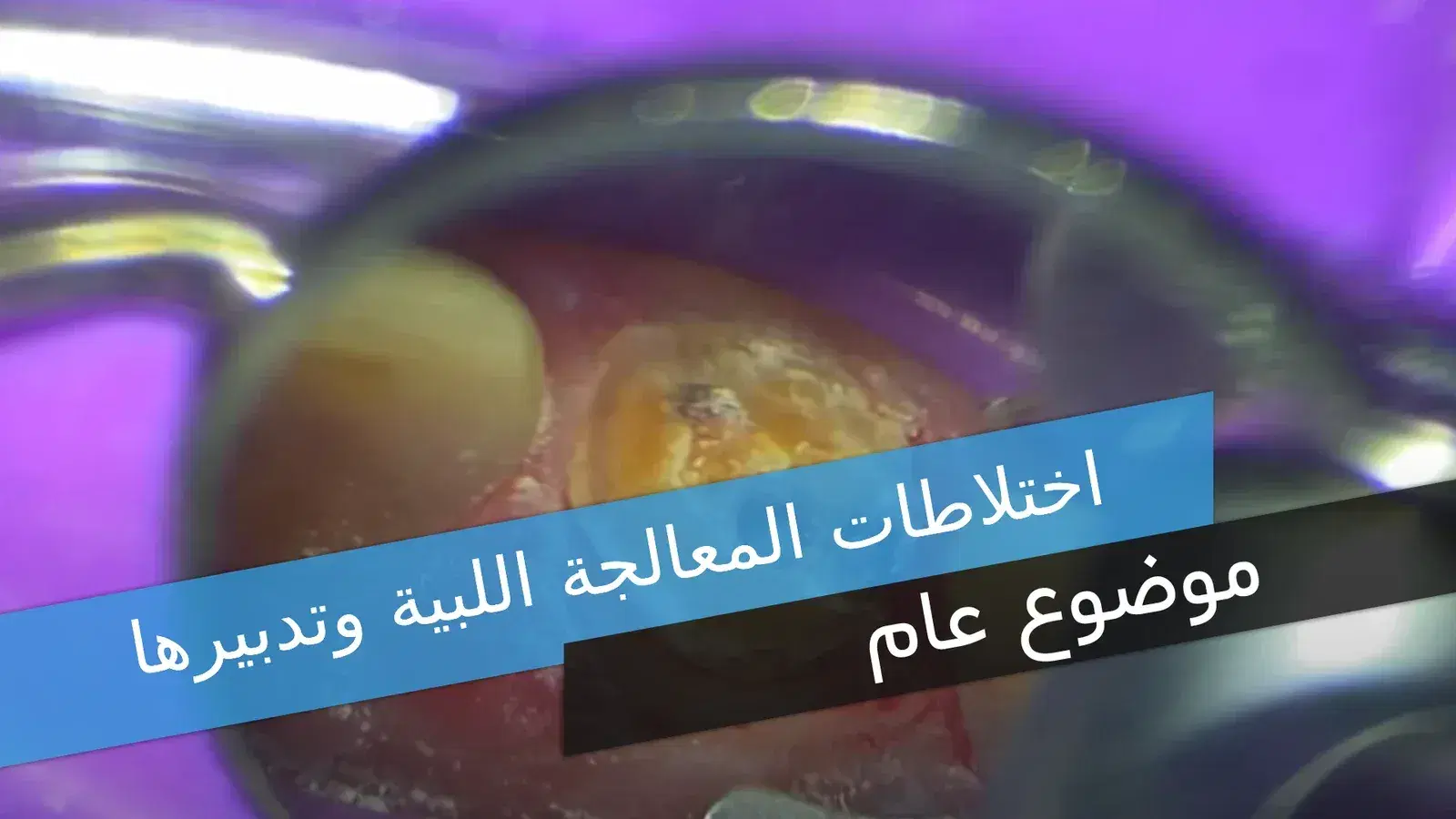 اختلاطات المعالجة اللبية وتدبيرها