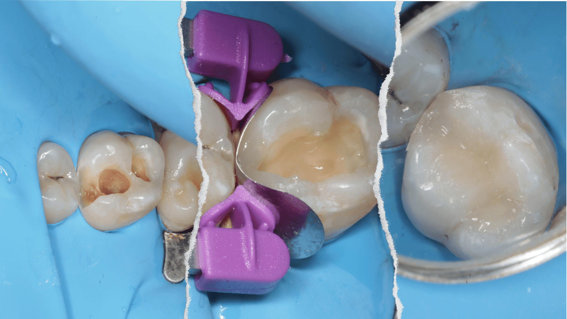 Mastering Posterior Composite Restoration